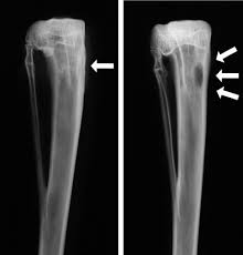 Image result for Osteomyelitis