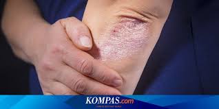 Analisis pada telapak tangan telah lama dipraktekkan oleh bangsa yunani. Kenali Jenis Dan Gejala Penyakit Kulit Autoimun Psoriasis Halaman All Kompas Com