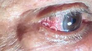 Infeções causadas por parasitas intestinais. Filariose Ocular Video Mostra Parasita De 15 Cm Sendo Retirado De Olho De Paciente