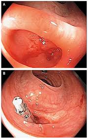 Image result for Colonoscopy in GI Bleeding