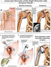 Pin On Avascular Necrosis Avn