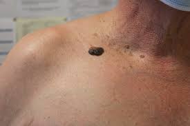 Is it possible to have a malignant melanoma or skin cancer if you have a mole that doesn't fit the abcd standard? Big Black Mole Is It A Melanoma Skin Cancer Dermoscopy