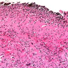 Candida esophagitis (see the image below) is the most common type of infectious esophagitis. Non Reflux Esophagitis A Review Of Inflammatory Diseases Of The Esophagus Exclusive Of Reflux Esophagitis Sciencedirect