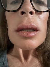 Has anyone else experienced unbearable lip pain after dental implant  surgery?