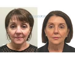 PRX Glow Treatment Treatments