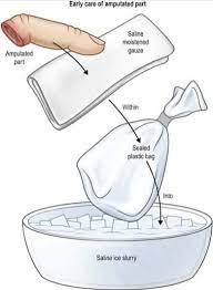 Kata شيئاً (sesuatu apapun) adalah kata yang mengandung keumuman, sehingga mencakup menyambung rambut dengan rambut asli ataupun. Letak Ais Pada Anggota Badan Terputus Boleh Menyelamatkannya Ini Fakta Yang Perlu Anda Tahu