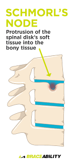 Pin On Back Injuries Spine Disorders What S Causing My Back Pain Lower Middle Upper Back Problems