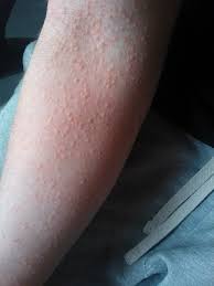 Image result for Papular urticaria