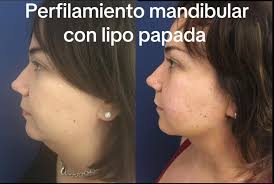 Resultados de antes y después de Perfilamiento mandibular con #lipopap...