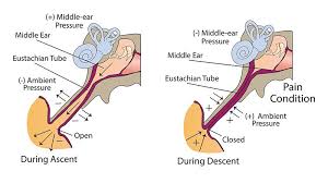 Image result for Inner Ear Decompression Sickness