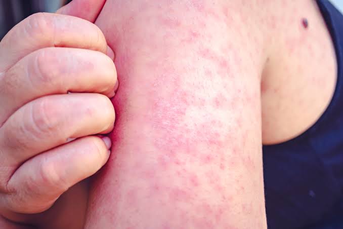 Case of measles reported in western North Dakota county • North Dakota  Monitor