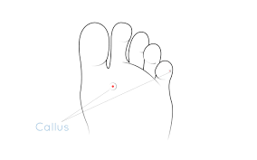 This could be warts and cysts. Callus Formation Foot Prevent Foot Corn Foot Clinic London
