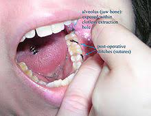 Check spelling or type a new query. Alveolar Osteitis Wikipedia