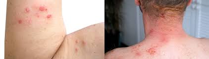 Image result for shingles