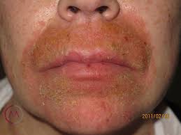 Image result for dermatitis contacta