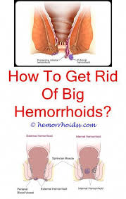 How To Reduce Hemorrhoids Naturally How To Get Rid Of Hemorrhoids When Pregnant How Do Hemorrh Hemorrhoids Treatment Bleeding Hemorrhoids Hemorrhoid Remedies