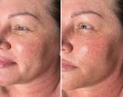 Jet Plasma Revitalization — BE:WELL