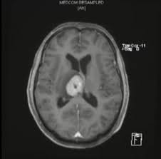 Dr John Tickell campaigning against brain cancer 'caused' by mobile phones 