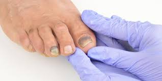 Los hongos en las uñas también se denominan «onicomicosis». Como Reconocer El Melanoma En Las Unas Cuidateplus