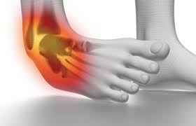 Planting the foot on an uneven surface causing the ankle to twist 8. The Difference Between A Sprained Ankle And A Broken Ankle