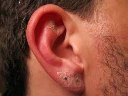 While ear piercing is usually a pretty safe procedure, it can also cause infections when it's not done properly. Infected Ear Piercing Causes And Treatments