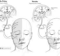 Anatomy: Stroke vs Bells Palsy