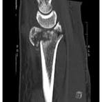 Distal radius volar rim plate: Technical and radiographic ...