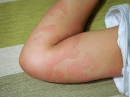 This may help you and your doctor identify triggers. Signs You Re Having An Allergic Reaction And When To See The Doctor