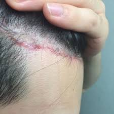 If you want to speed up the process, you might be able to remove the hair. Ingrown Hairs On Scalp