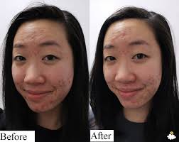 Dùng thử toner giấm táo trị mụn “thần thánh”, cô nàng này đã rút ra kết  luận đau thương