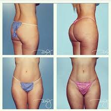 Pin By Selene Rizo On Surgery Body Contouring Mommy Makeover Tummy Tucks