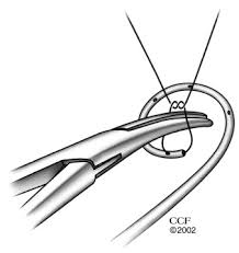 Urethral stent is generally a tube which comes from the kidney to the bladder, bypassing the stone or an obstruction. Shortened Pull String Simplifies Office Based Ureteral Stent Removal Sciencedirect