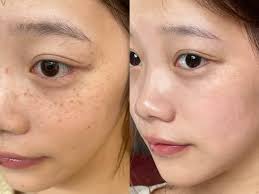 又平又好用，一次10分鐘，keep住用佐大半年，皮膚白淨佐，斑點都淺佐！  #女藝人同款居家無痛祛斑，連們都唔使出，自己輕鬆搞掂，唔會痛，唔會好似激光一樣損傷皮膚，都冇尷尬期！！