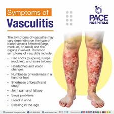 Image result for Vasculitis