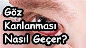 Goz Kanlanmasi Nasil Gecer Gozler Saglik
