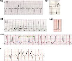 Svt takes stock ford vehicles, and tunes them to add more horsepower, and they even add performance inspired styling cues. Supraventricular Tachycardia An Overview Of Diagnosis And Management Rcp Journals