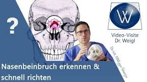 Nasenbeinbruch Erkennen Richtig Richten Sofortmassnahmen Bei Gebrochener Nase Und Nasenbluten Youtube
