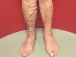 Krampfadern werden in der medizin als varizen bezeichnet (krampfaderleiden: Varizen Dr Med Thomas Heisterkamp Dermatalogisch Phlebologische Praxis