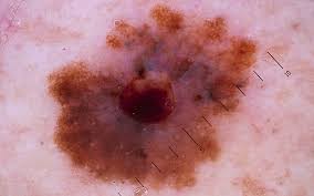 The skin is made up of three layers, including the epidermis, which is the top layer of the skin. How Do I Check Myself For Melanoma Melanoma Institute Australia
