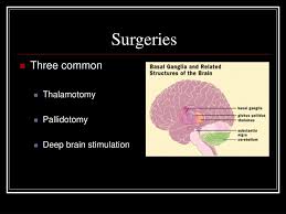 Image result for Pallidotomy