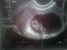 What it would look like. 8 Week Ultrasound The Shrum Trilogy