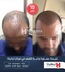 إليكم هذه النتيجة بعد 10 أيام من زراعة الشعر في مركز تركيانا الفريق الطبي يرحب بالاجابه على hair transplant cosmetic surgery plastic surgery