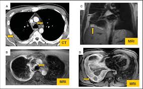 Check spelling or type a new query. Pdf Malignant Pleural Mesothelioma A Comprehensive Review Semantic Scholar