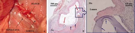Dacron needs to be heated with an iron to the correct temps for the maximum tautness. Hyaluronic Acid Biodegradable Material For Reconstruction Of Vascular Wall A Preliminary Study In Rats Pandis 2011 Microsurgery Wiley Online Library