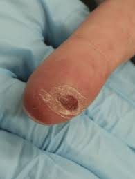 Image result for syphilis ulcer