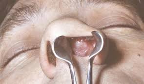 Zelenyashij Streptokokk V Nosu Recept Poshagovyj S Foto