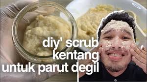 10 cara hilangkan jerawat secara semulajadi dan selamat. Cara Cepat Hilangkan Bekas Jerawat Hilangkan Parut Jerawat Youtube