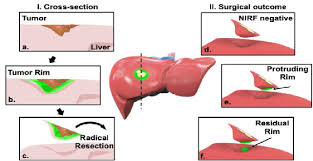 Cirrhosis of the liver (relates to chapter 42, nursing management: 3d Diagram Of The Liver Figure 10 From Automatic Slice Growing Method Based 3d Reconstruction Of Liver With Its Vessels Semantic Scholar Bile Is A Mixture Of Water Bile Salts