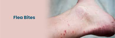 Image result for flea bites