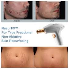 Bio Oil Results On Stretch Marks Before And After Lumenis M22 Resurfx Laser Skin Resurfacing Stretch Marks Bio Oil Stretch Marks